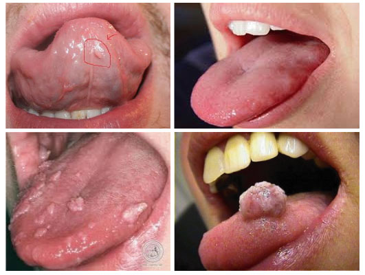 hình ảnh triệu chứng bệnh sùi mào gà ở lưỡi