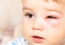 biểu hiện bệnh viêm bờ mi mắt ở trẻ em