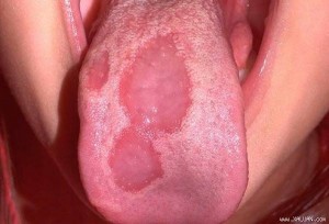 dấu hiệu ung thư lưỡi nấm
