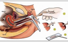 Khám phụ khoa bằng mỏ vịt có đau không