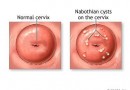 nang naboth cổ tử cung là gì nang naboth cổ tử cung có nguy hiểm không
